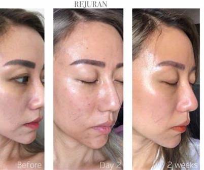 REJURAN Dual Effect Ampoule (DOT Dual c-PDRN®) – Blog Review & User Experience