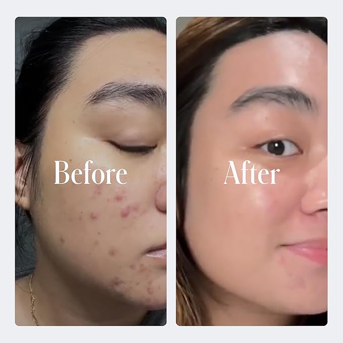Geologie Clear System | 3-Step Acne Treatment & Skincare Set | Clears Skin Fast | Acne Gel Cleanser, SPF15 Day Cream & .2% Retinol Face Cream For Men & Women | Month 2 / Level 2