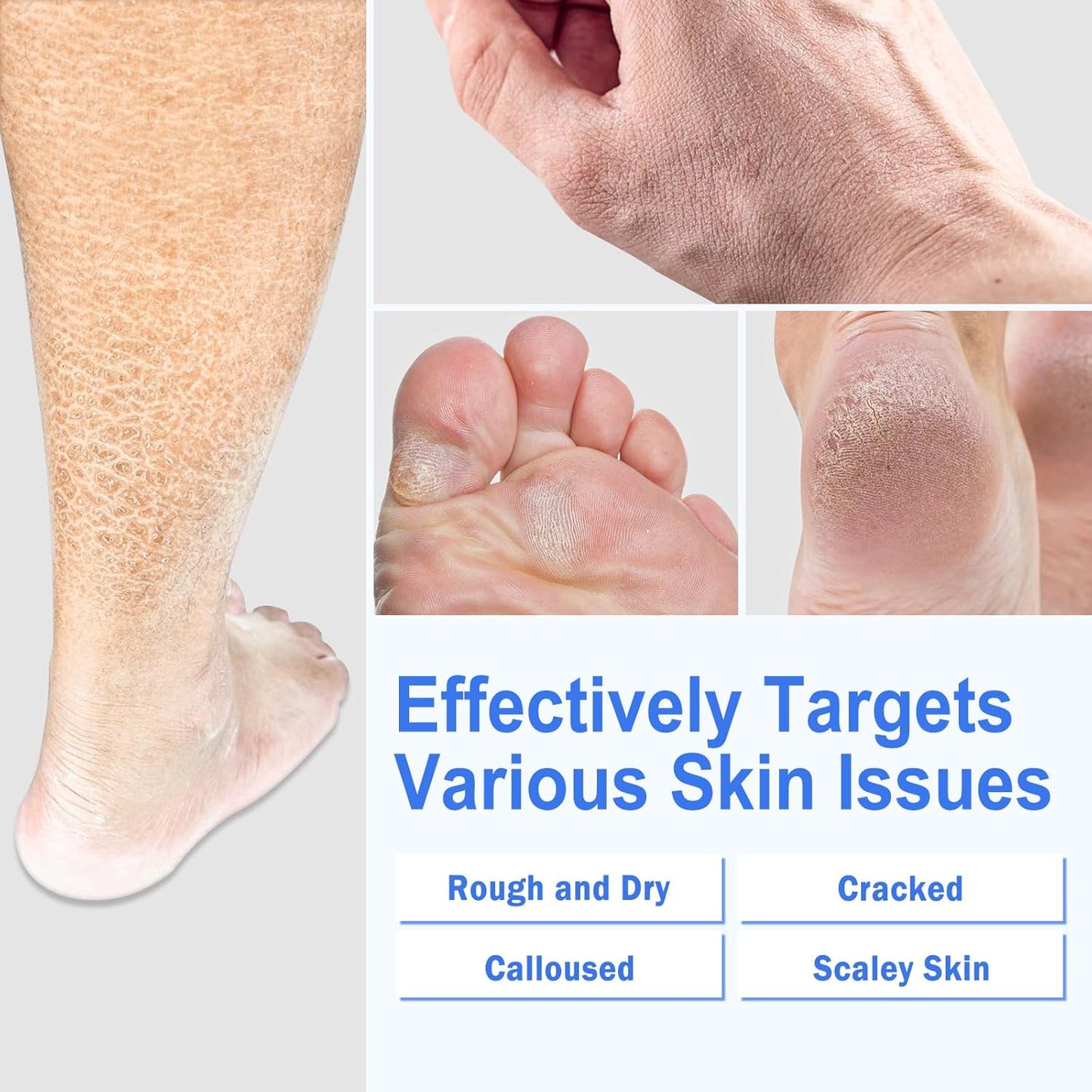 Ultra-Hydrating Urea Cream (Urea Conc. 40.67%), Foot Cream for Dry Cracked Heels and Feet, Pair with Moisturizing Heel Socks for Cracked Heel Treatment, Heel Socks Included (5.29 OZ/150g)