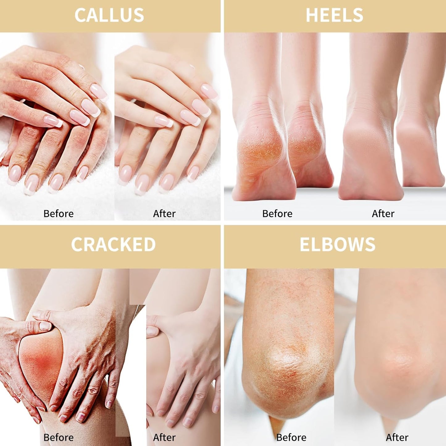 Urea Cream 50 Percent for Feet Maximum Strength 5.29 oz with Oat and 2% Salicylic Acid, Foot & Hand Cream included Hyaluronic Acid, Tea Tree and Aloe Vera for Deep Moisturizing, Callus Removing