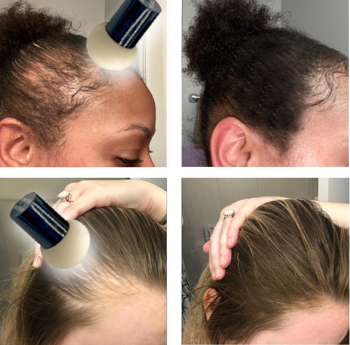 KERATIN RESEARCH Hairline Filler Unisex Mineral Powder Root Touch-Up Hair loss Concealer Scalp & Beard Bald Patch Coverage Fibers for Thinning Hair Waterproof Organic Natural look (DARK BLONDE, XL)