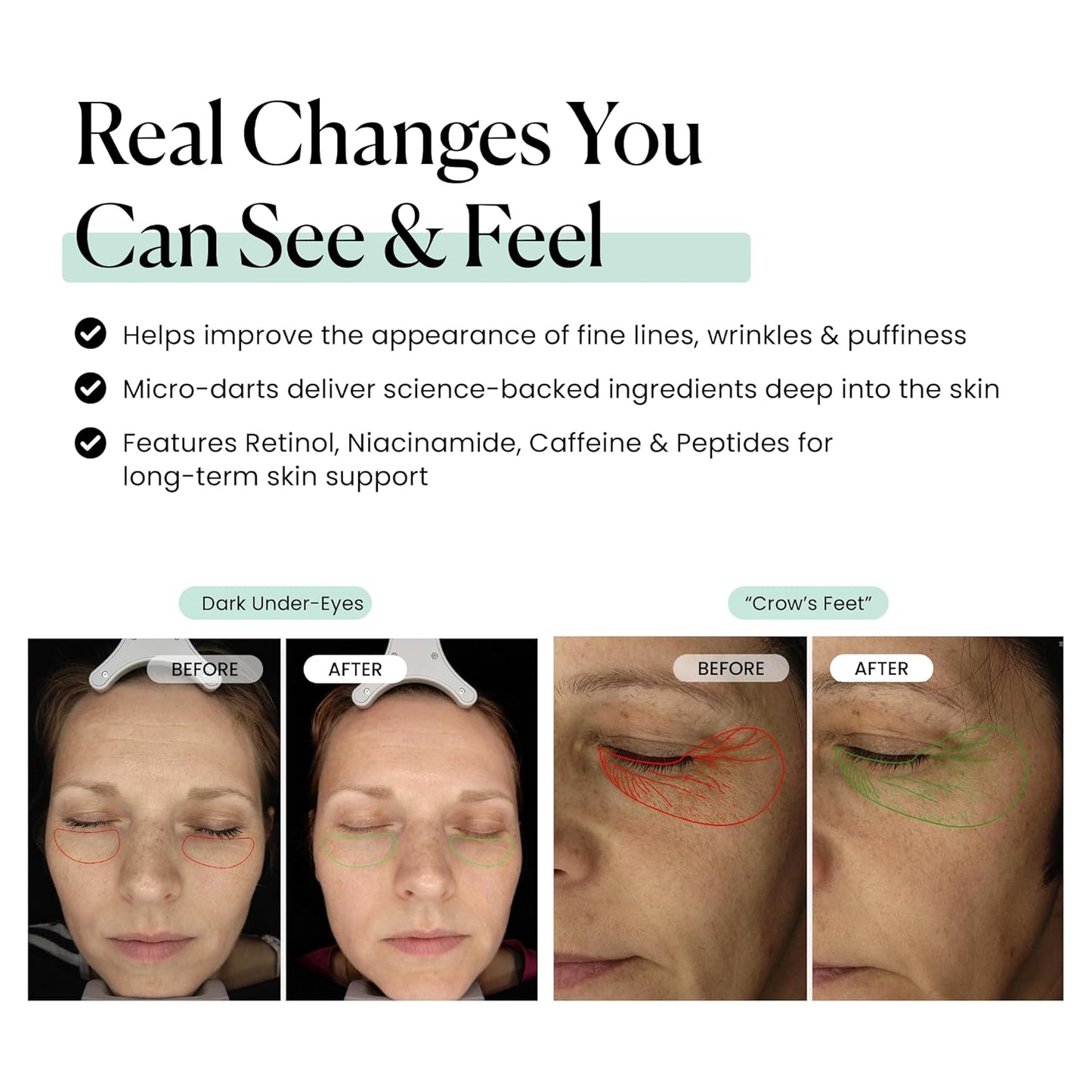 Qure Skincare MicroInfusion Targeted Patches - 8 Pairs of Targeted Under Eye Patches Formulated for Fine Lines & Wrinkles - Retinol, Caffeine, Niacinamide & Peptides - Dissolvable for Overnight Use