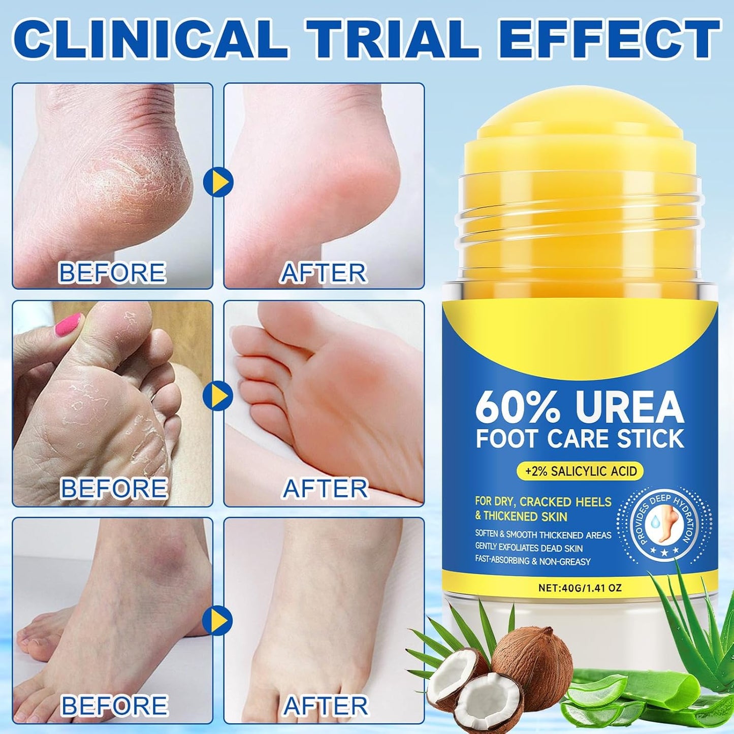Urea Cream Stick 60% plus 2% Salicylic Acid,urea cream percent for feet maximum strength,Foot Lotion Stick for Cracked Heels,Dry Hands & Rough Knees,Callus Remover & Skin Softener, Soften Dead (1)