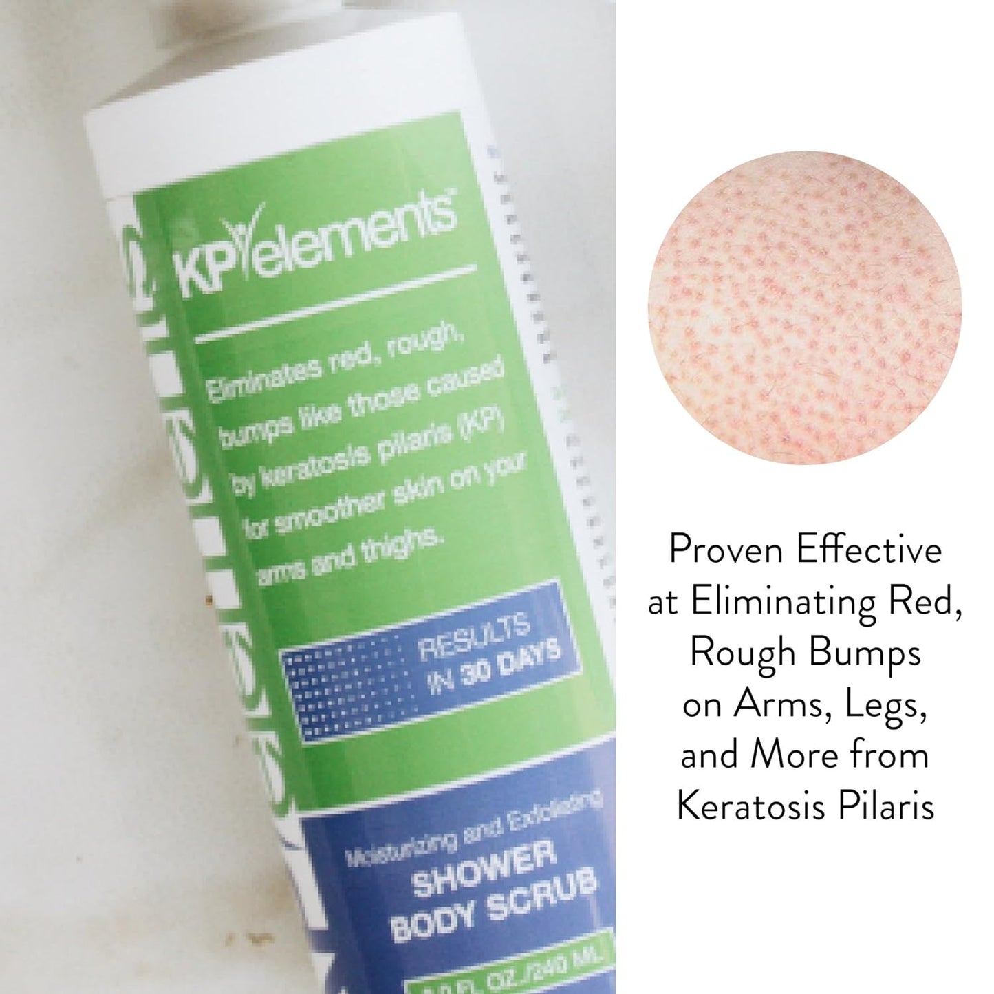 KP Elements Body Scrub (8 fl oz) | Keratosis Pilaris Treatment | Exfoliating Body Scrub and Body Moisturizer for Dry Skin | Helps Reduce Red Bumps | Body Skin Care Product for Men and Women